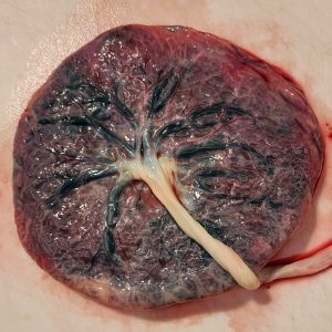 Fourever Placenta Tree Of Life Massachusetts CT NH RI